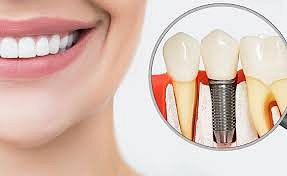 Dental Implant Treatment- Kannur, Kerala